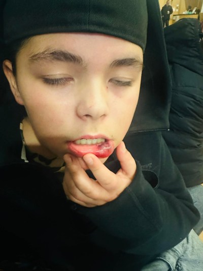 Submitted by Melissa Johnson 

Theo Osborne, 11, shows the injuries to his mouth after being attacked.